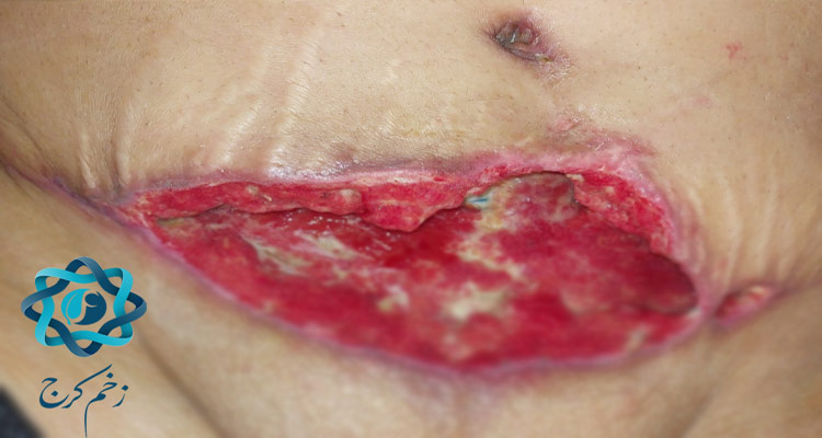 درمان زخم های جراحی در منزل