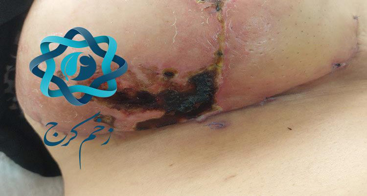 درمان زخم های جراحی در منزل