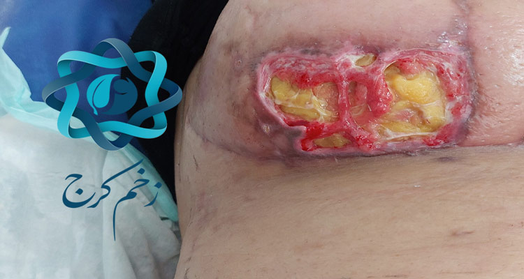 درمان زخم های جراحی در منزل