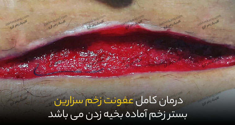 درمان کامل عفونت بخیه سزارین