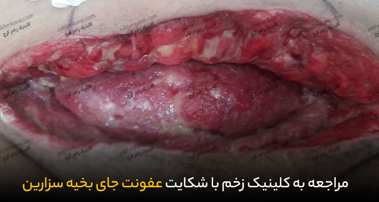 عکس عفونت بخیه سزارین