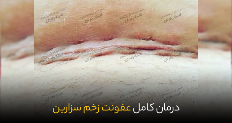 نتیجه نهایی درمان زخم عفونت سزارین