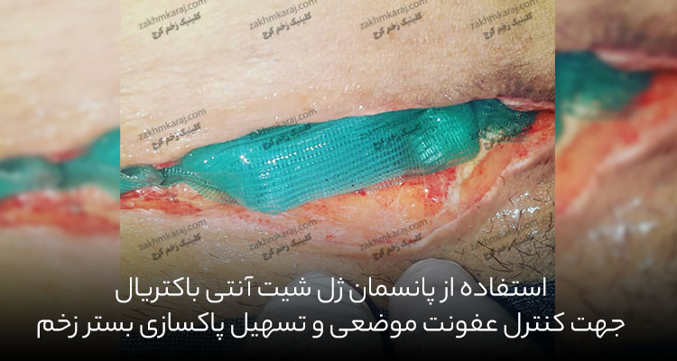 پانسمان و درمان عفونت بخیه سزارین