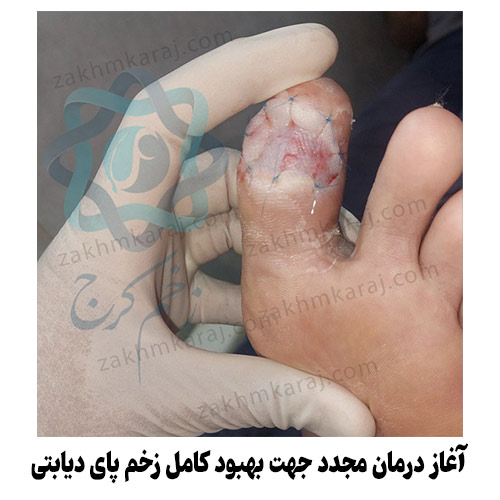 آغاز دور جدید درمان جهت بهبود کامل زخم پای دیابتی