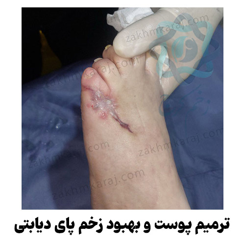 ترمیم پوست و بهبود زخم پای دیابتی پس از درمان تخصصی