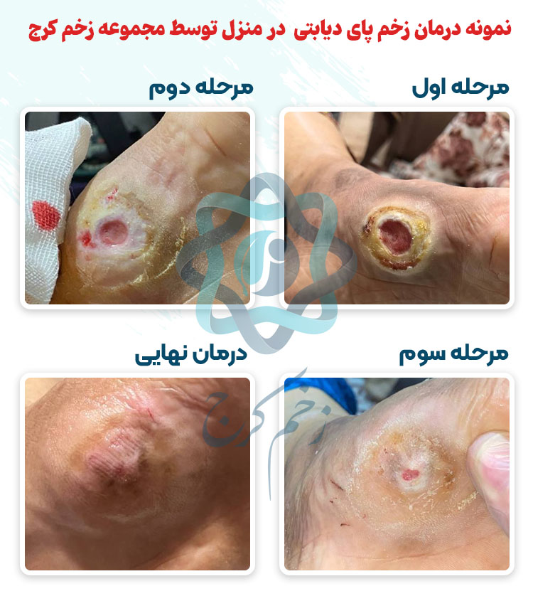 درمان زخم پای دیابتی در کلینیک زخم کرج