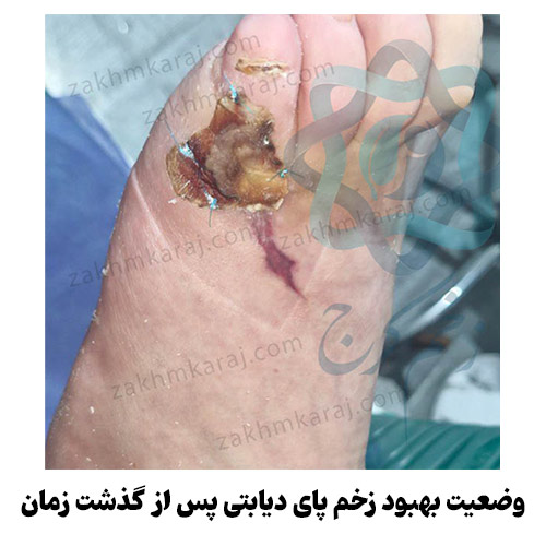 وضعیت بهبود زخم پای دیابتی پس از گذشت زمان