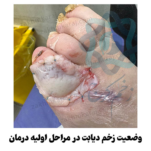 وضعیت زخم پای دیابتی در مراحل اولیه درمان