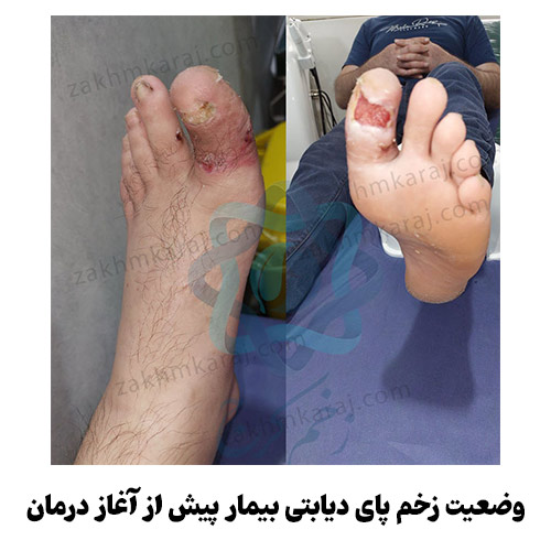 وضعیت زخم پای دیابتی بیمار پیش از آغاز درمان