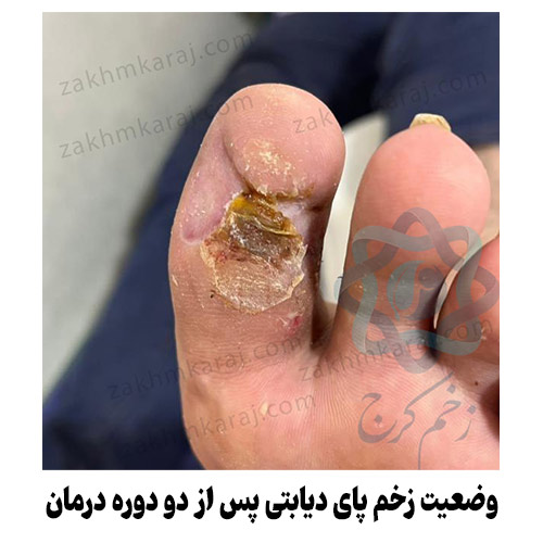 وضعیت زخم پای دیابتی بیمار پس از دو دوره درمان
