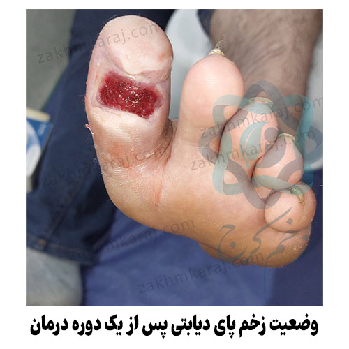 وضعیت زخم پای دیابتی پس از یک دوره درمان