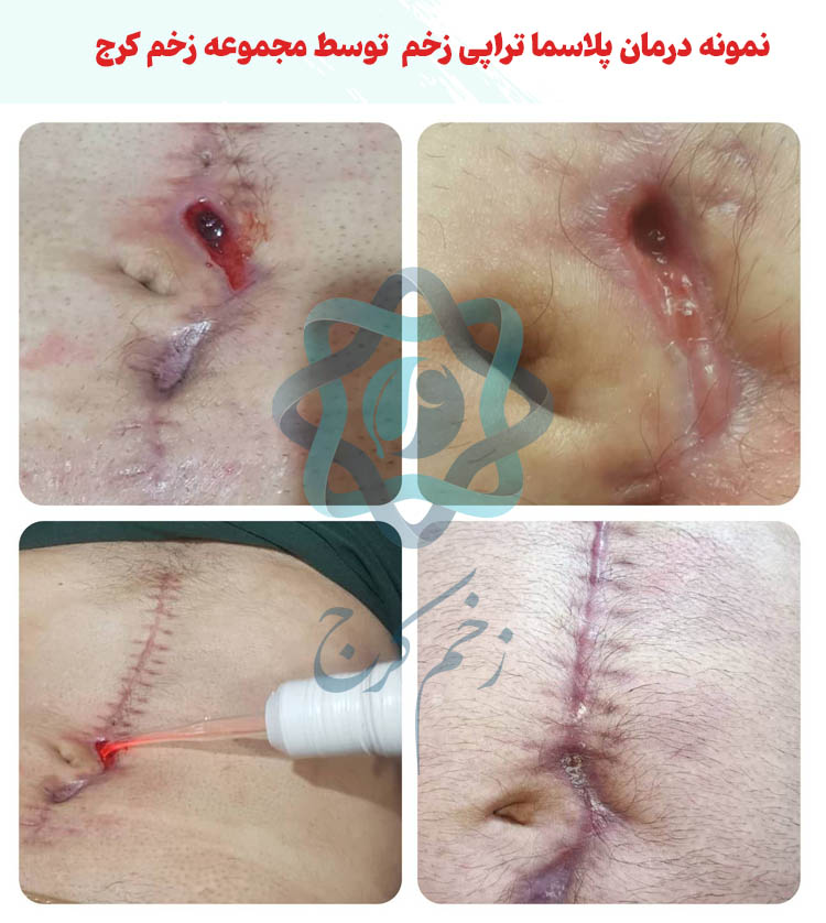 عکس پلاسما تراپی زخم