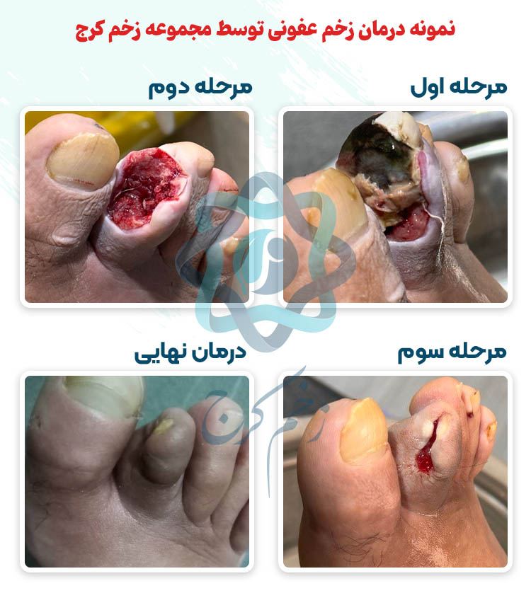 درمان زخم عفونی