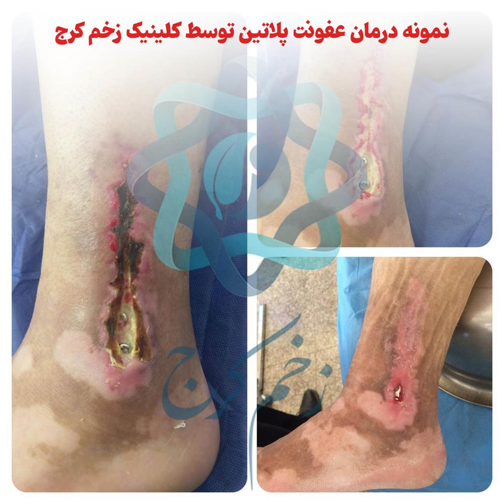 درمان عفونت پلاتین