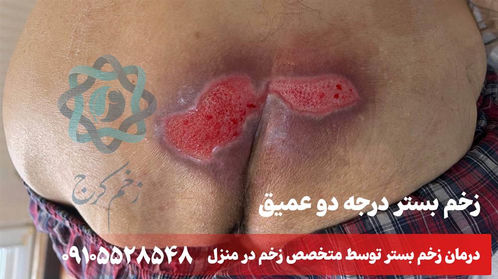 زخم بستر درجه 2 عمیق