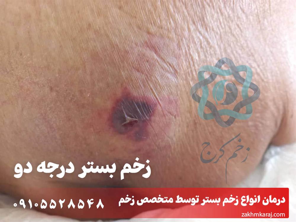 زخم بستر درجه دوم
