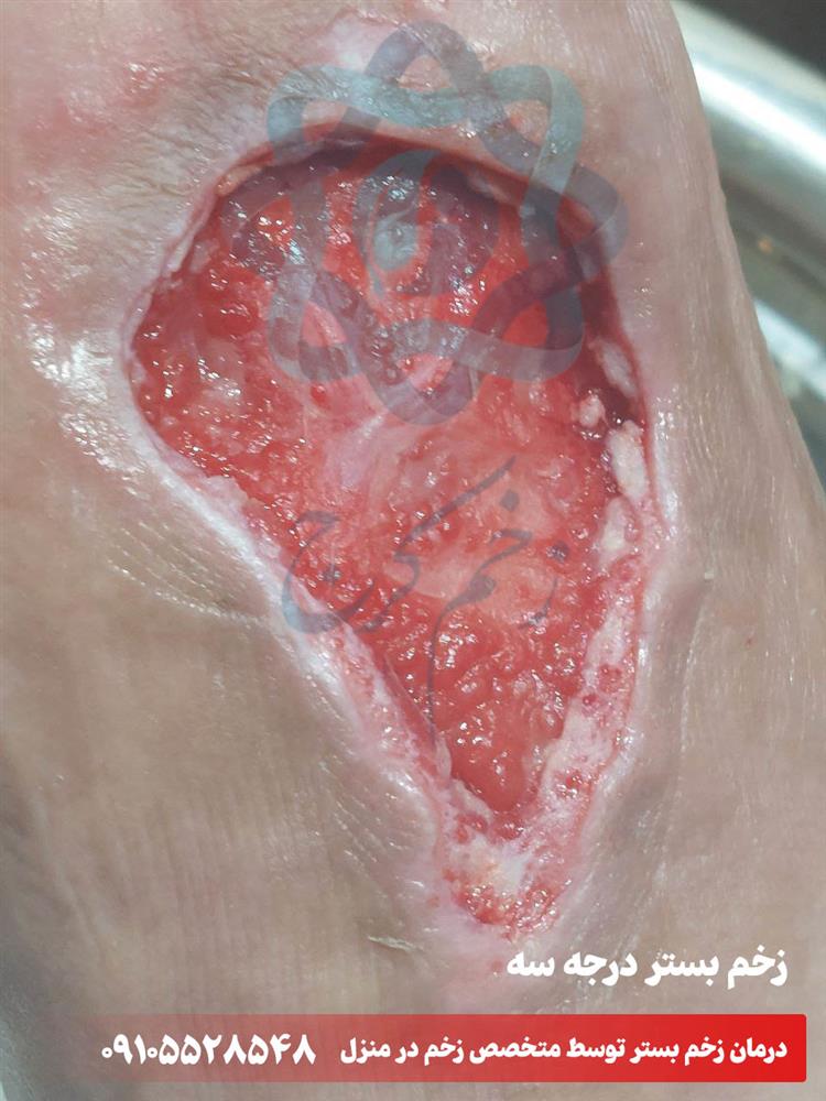 زخم بستر درجه 3