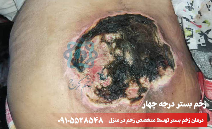 زخم بستر درجه 4