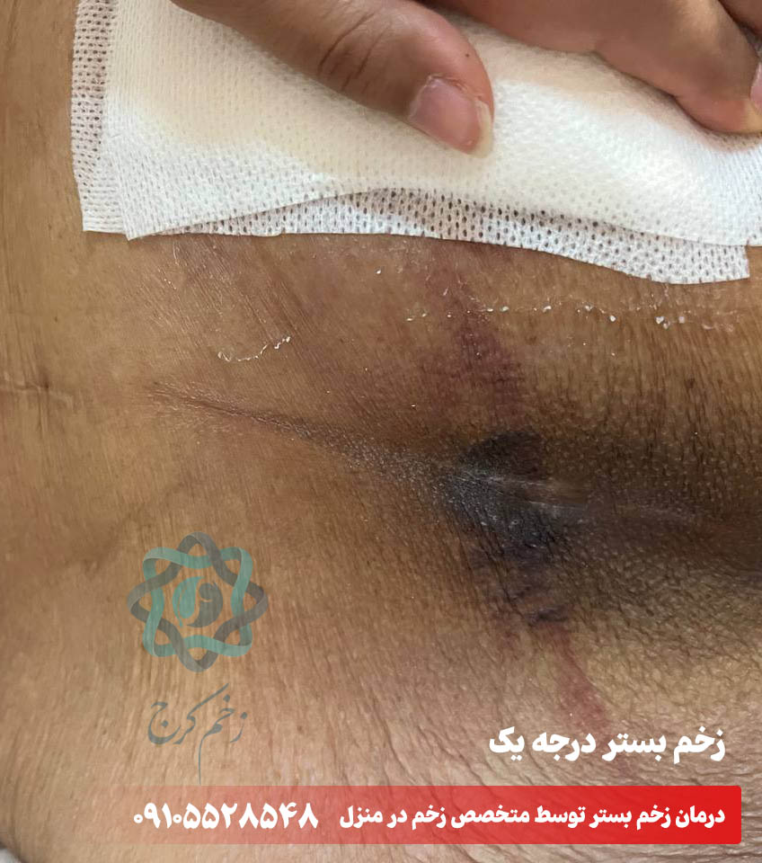 زخم بستر درجه یک