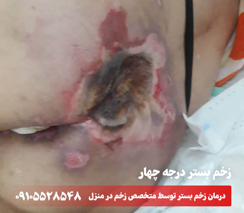 زخم بستر درجه چهار