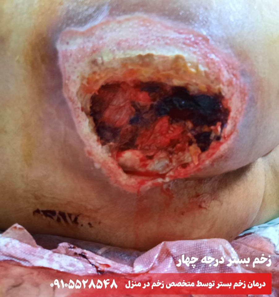 زخم بستر گرید چهار