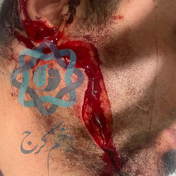 تصویر اول - بریدگی صورت با چاقو