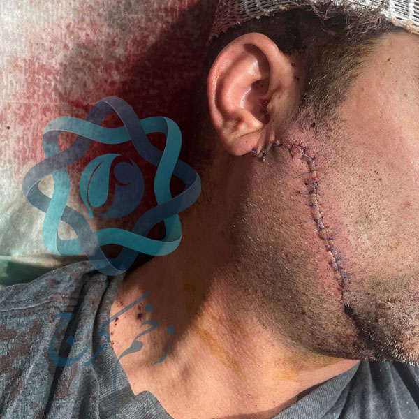 درمان و بخیه جای زخم با چاقو