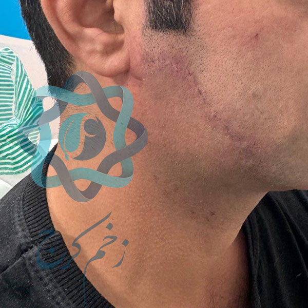 درمان کامل جای بریدگی صورت با چاقو