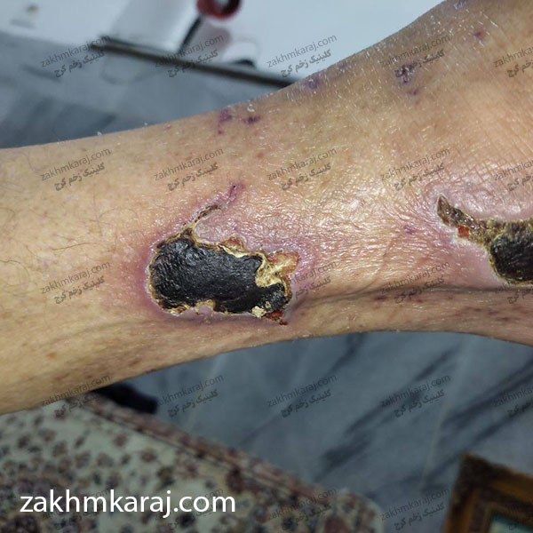 زخم شریانی ساق پا