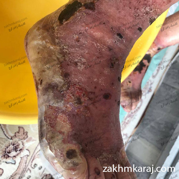 زخم شریانی پا