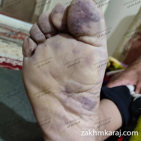 زخم شریانی کف پا