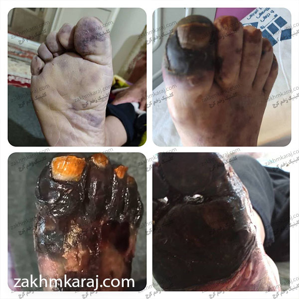 مراحل ایجاد زخم شریانی