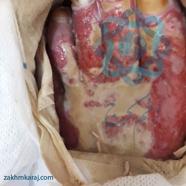 لارو درمان زخم