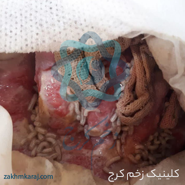 درمان زخم به روش لارو