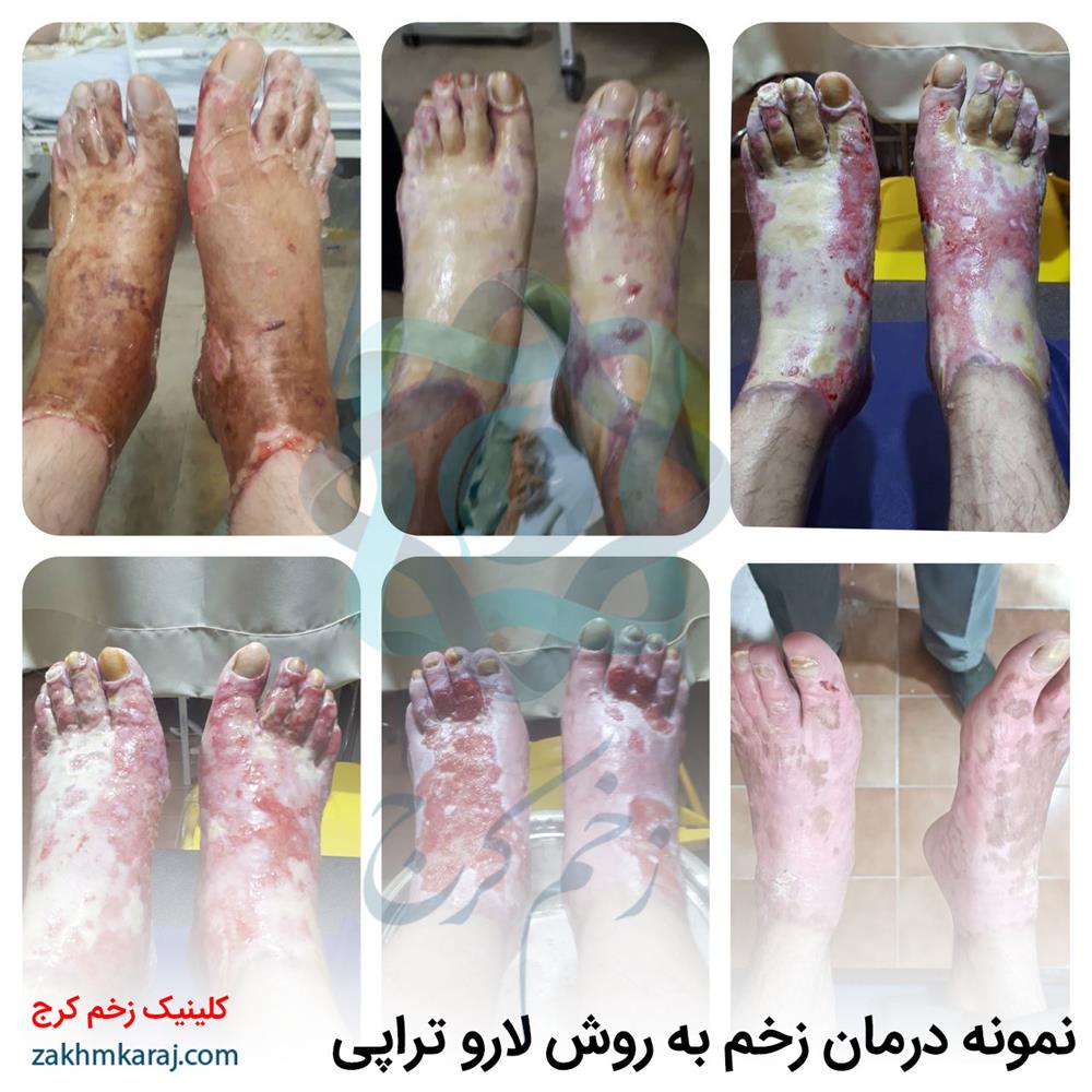 نمونه درمان زخم به روش لارو تراپی