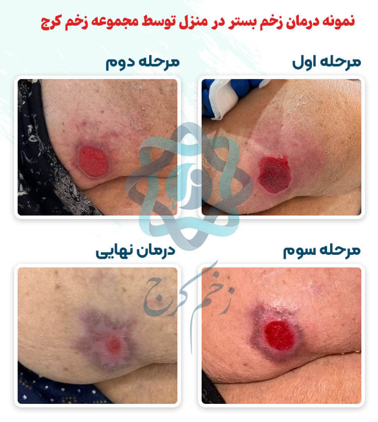 نمونه درمان زخم بستر در منزل