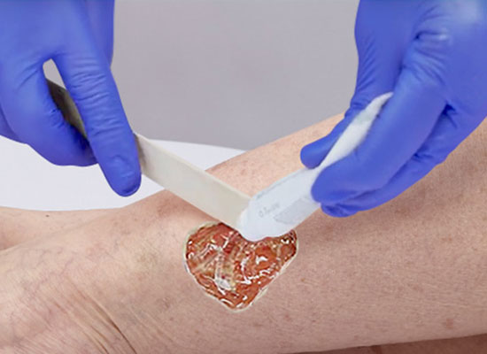 دبریدمان زخم در کلینیک زخم کرج