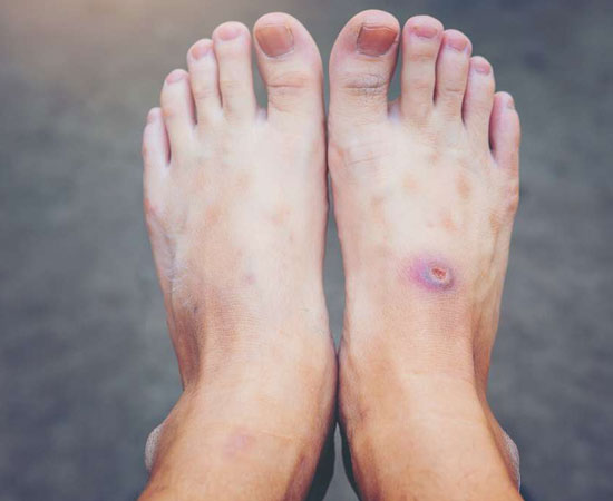 درمان زخم دیابتی در منزل