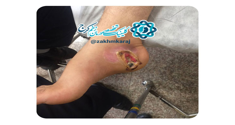 مارگزیدگی و احتمال قطع عضو