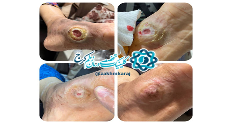 تاثیر آفلودینگ نرم در تسریع بهبود زخم پای شارکو