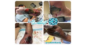 نقش مثبت قطع ‌عضو در حفظ ‌جان ‌بیمار دارای عضو گانگرن