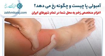 آمبولی پا چیست و چگونه رخ می دهد؟