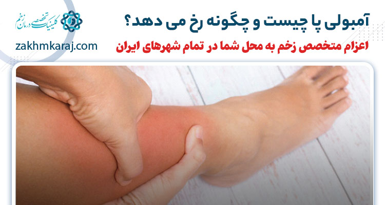 آمبولی پا چیست و چگونه رخ می دهد؟