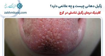 زگیل دهانی چیست و چه علائمی دارد؟