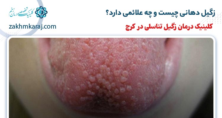 زگیل دهانی چیست و چه علائمی دارد؟