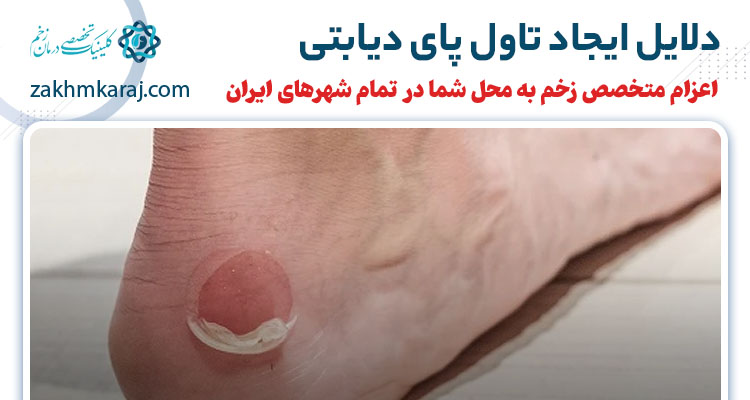 دلایل ایجاد تاول پای دیابتی