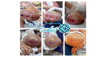 نقش درمان تیمی در جلوگیری از آمپوتاسیون مجدد ناشی از دهیسنس محل عمل جراحی قبلی