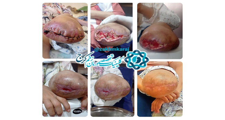 نقش درمان تیمی در جلوگیری از آمپوتاسیون مجدد ناشی از دهیسنس محل عمل جراحی قبلی