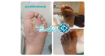 خطر آمپوتاسیون دنبال زالو درمانی در یک مورد زخم پای دیابتی