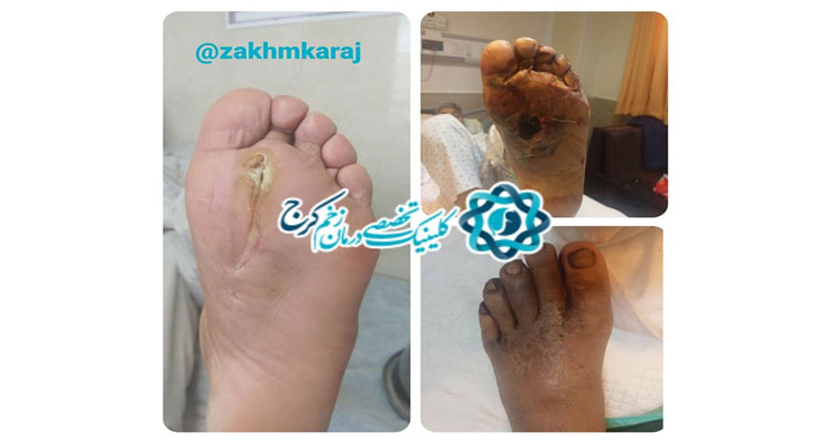 خطر آمپوتاسیون دنبال زالو درمانی در یک مورد زخم پای دیابتی